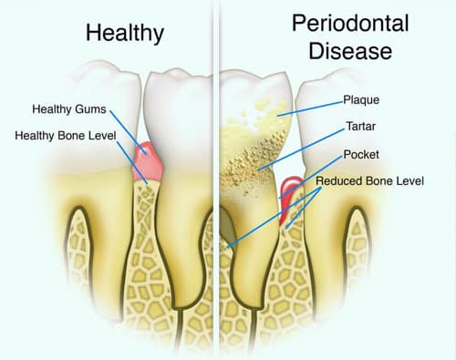 periodontics mcdonough ga - gum disease care dentists henry county