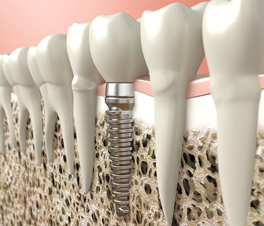 dental implants mcdonough ga - henry county dentists