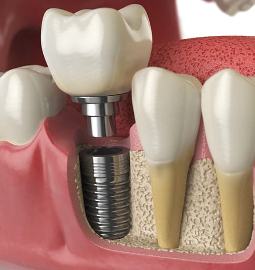 dental implant extraction mcdonough and henry county ga