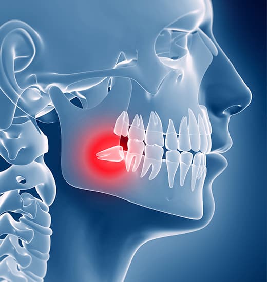 tooth extraction mcdonough and henry county ga