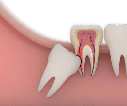 oral surgery mcdonough - tooth extraction dental care georgia