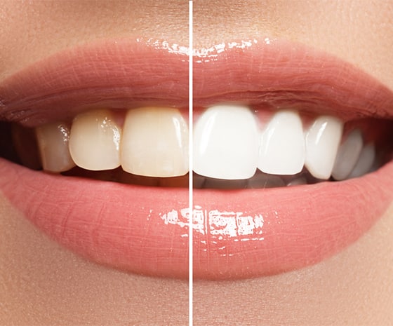 teeth whitening mcdonough - cosmetic dentist in henry county